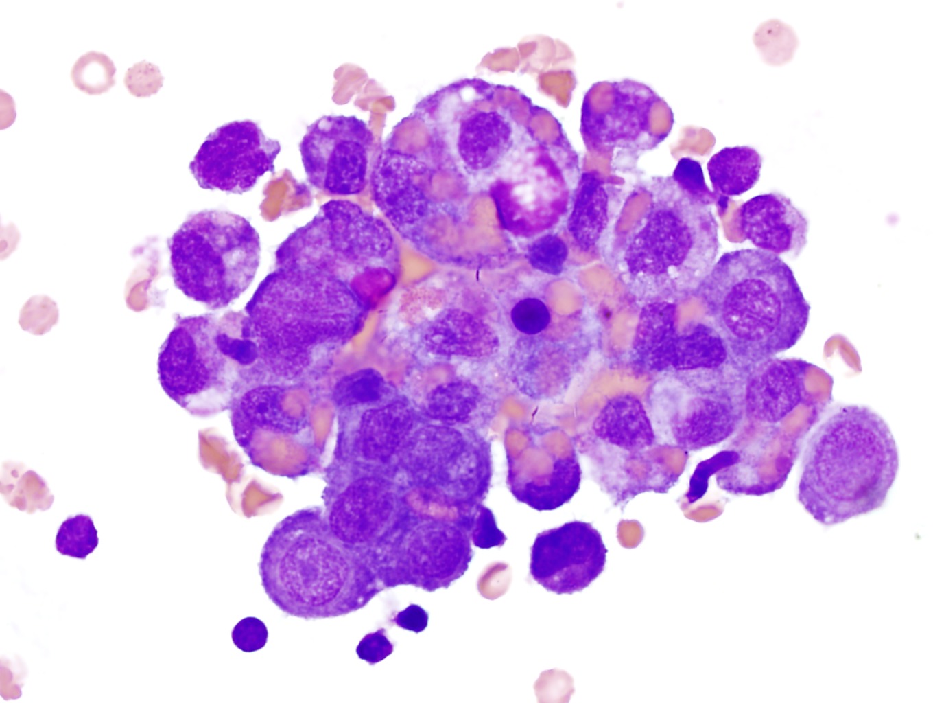 malignant cells in csf