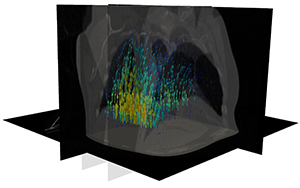 lung cancer sm